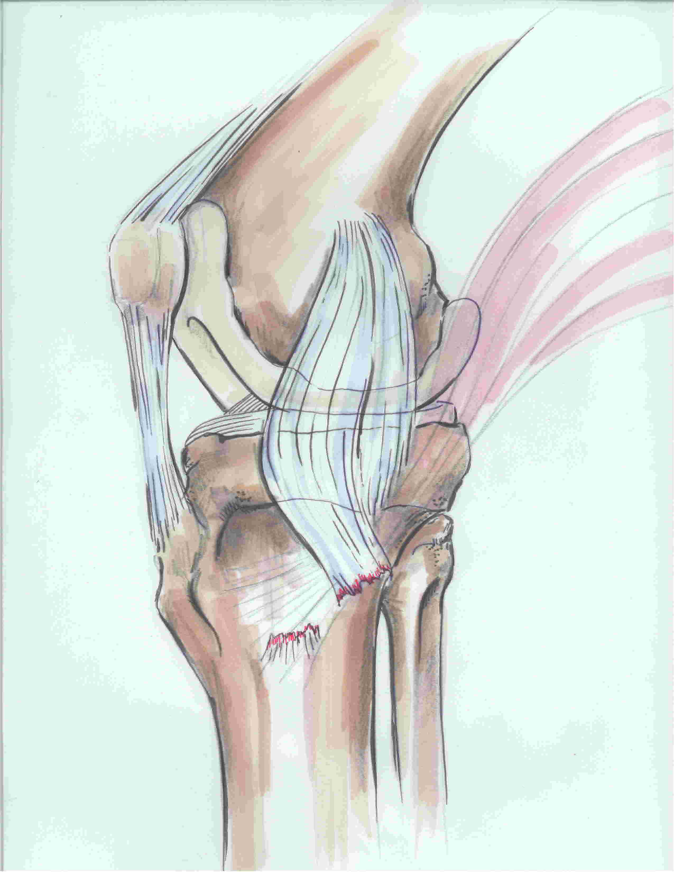 MCL Stener Lesion